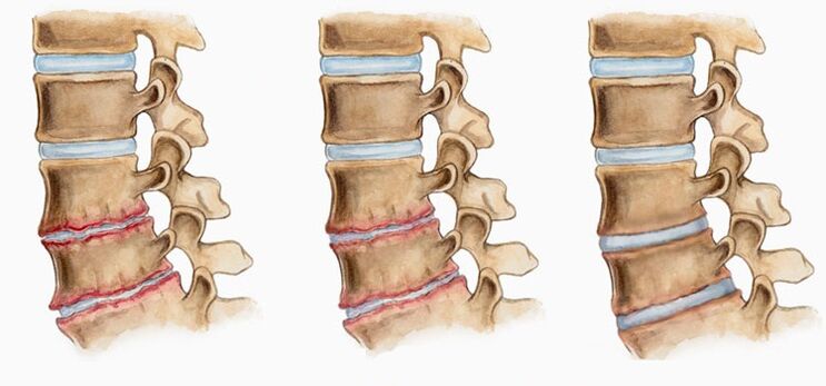 Deformação dos discos intervertebrais na osteocondrose pode causar dor nas costas