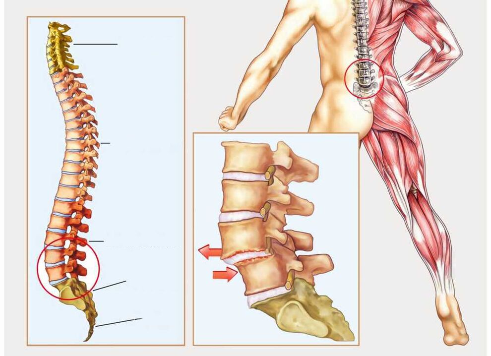 coluna saudável e doente