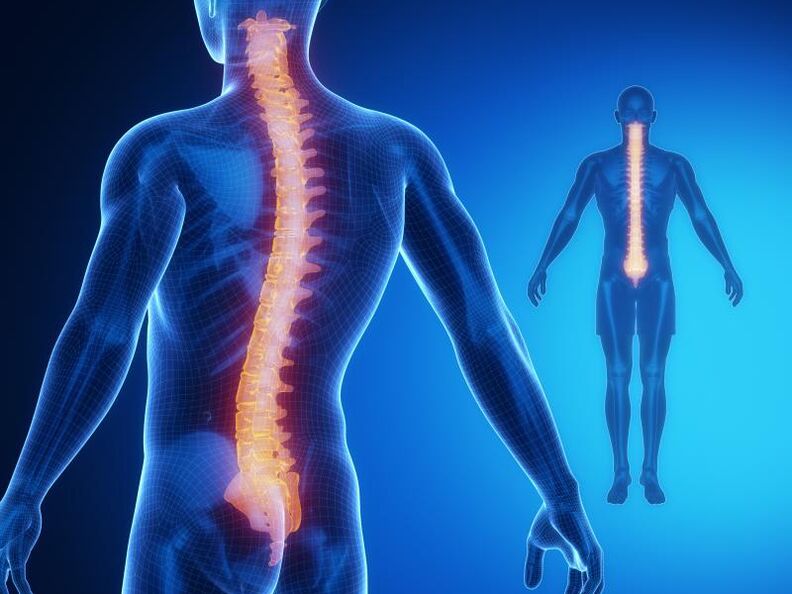 Osteocondrose da coluna vertebral, exigindo tratamento complexo